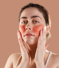 Redness and Rosacea Redness and Rosacea in Melbourne CBD