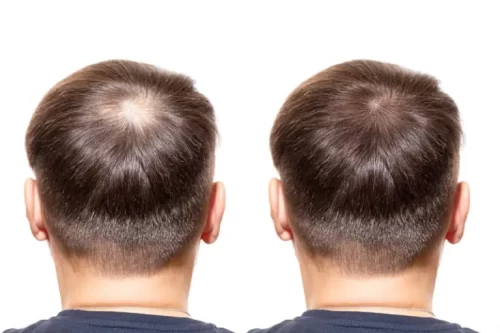 Mesotheraphy for hair loss treatment for men and women