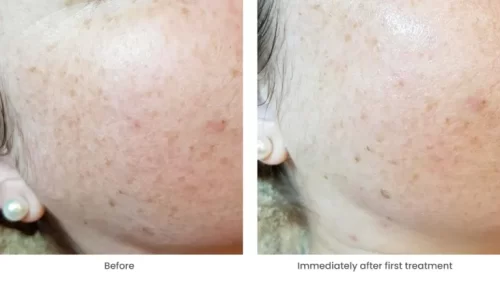 Radiant reveal peel in Melbourne CBD